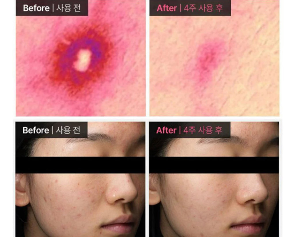 Dong-A Pharmaceutical Acne PRO Gel for Acne-Prone & Sensitive Skin 30ml