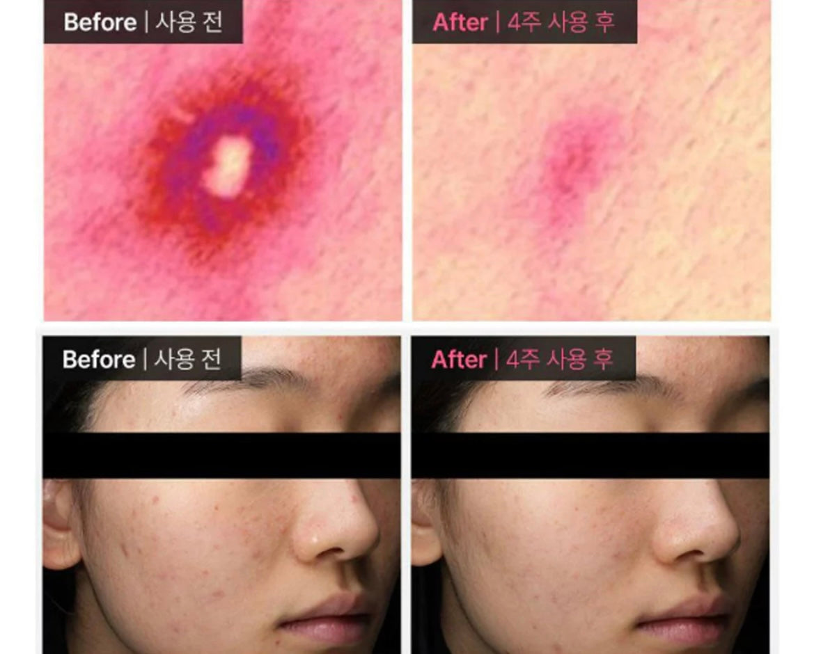Dong-A Pharmaceutical Acne PRO Gel for Acne-Prone & Sensitive Skin 30ml