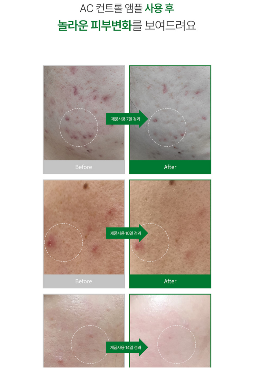 AC Control Ampoule | Acne Care, Sebum Balance & Soothing Treatment AC 컨트롤 앰플 | 여드름 피부 진정 & 피지 밸런스 케어