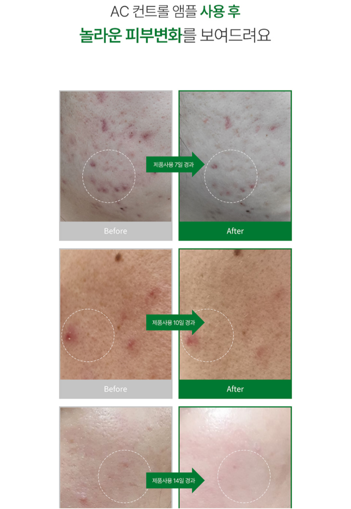 AC Control Ampoule | Acne Care, Sebum Balance & Soothing Treatment AC 컨트롤 앰플 | 여드름 피부 진정 & 피지 밸런스 케어