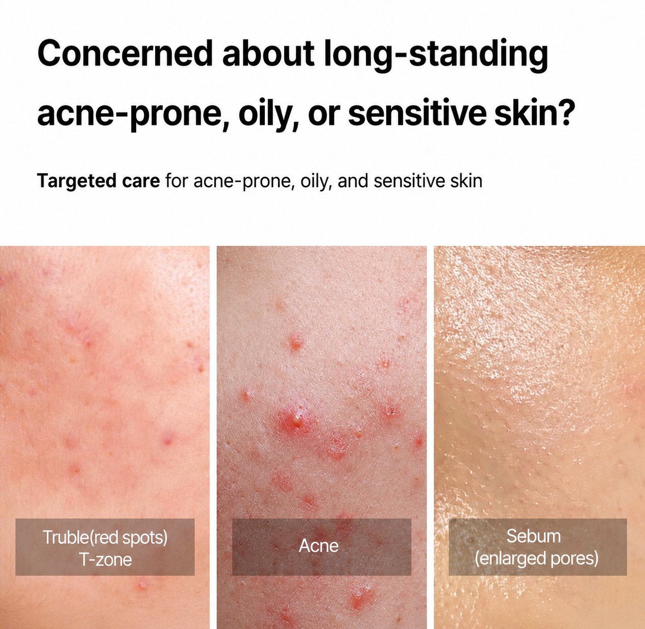 Dong-A Pharmaceutical Acnol Pro Daily Trouble Care Cream 30ml