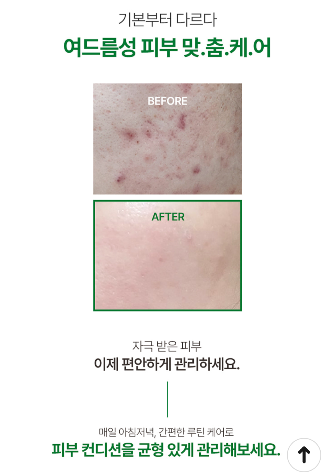 AC Control Ampoule | Acne Care, Sebum Balance & Soothing Treatment AC 컨트롤 앰플 | 여드름 피부 진정 & 피지 밸런스 케어