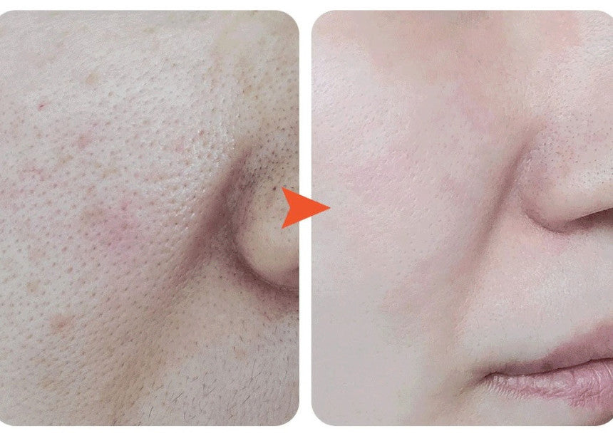 Premium Korean Salmon PDRN DNA Ampoule 5mlx10 Salmon Cream+MTS Roller